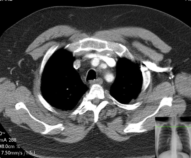 image-overlay-Chest CT Slice 1