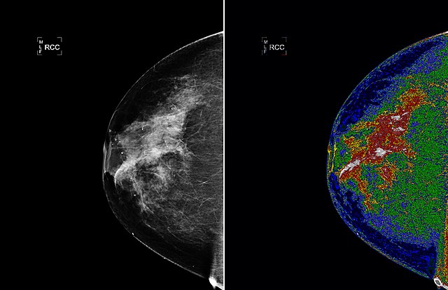 Cover Image for Mammography